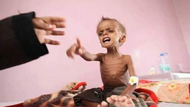 US insists on Continuing Suffering of Yemeni People