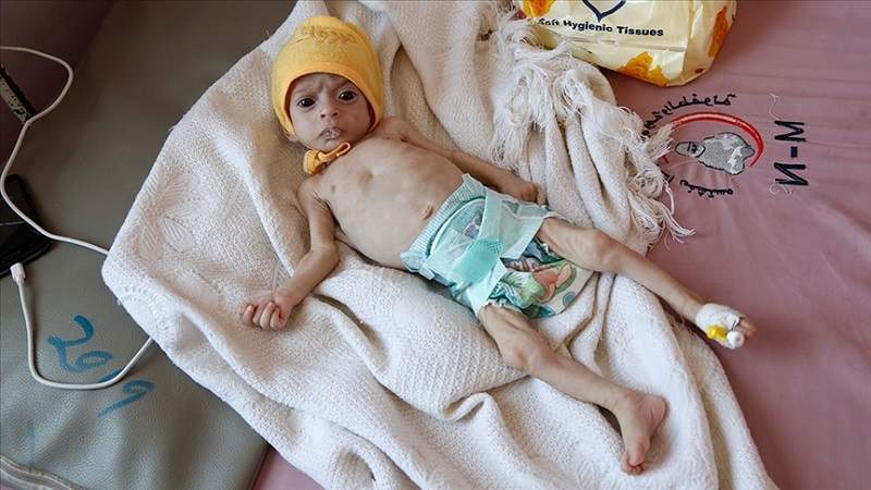 UNICEF: Acute Malnutrition Crisis Escalates in Yemen’s Occupied Regions, Critical Conditions on the West Coast