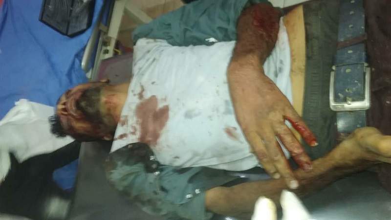 Civilians Injured by Explosion of Mine Remnant of US-Saudi Aggression 